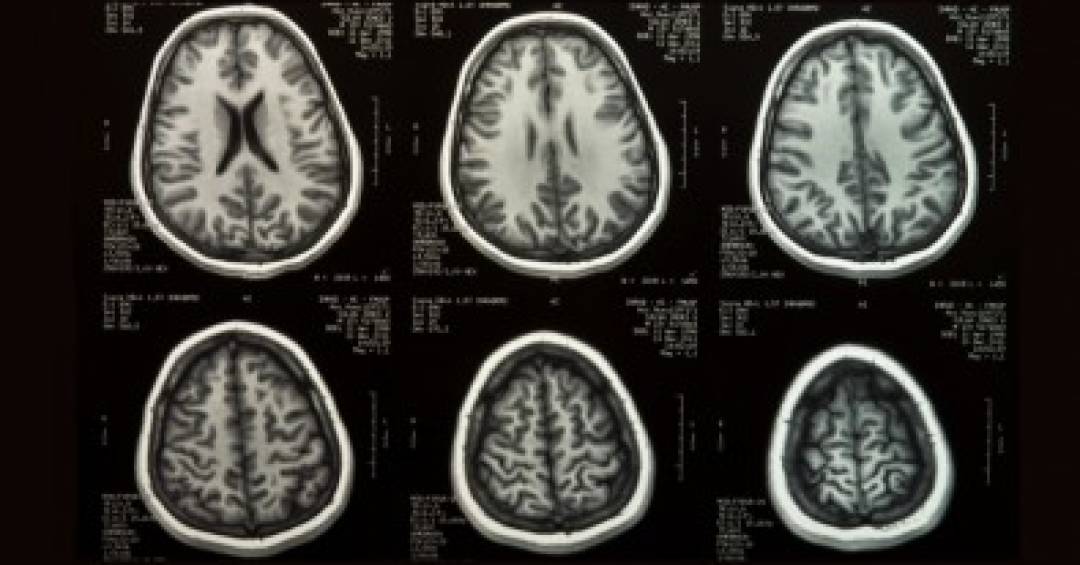 doenca-de-parkinson:-nova-pesquisa-abre-caminho-para-o-tratamento-com-celulas-tronco