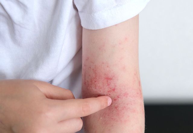 sus-inclui-3-novos-medicamentos-no-tratamento-de-dermatite-atopica