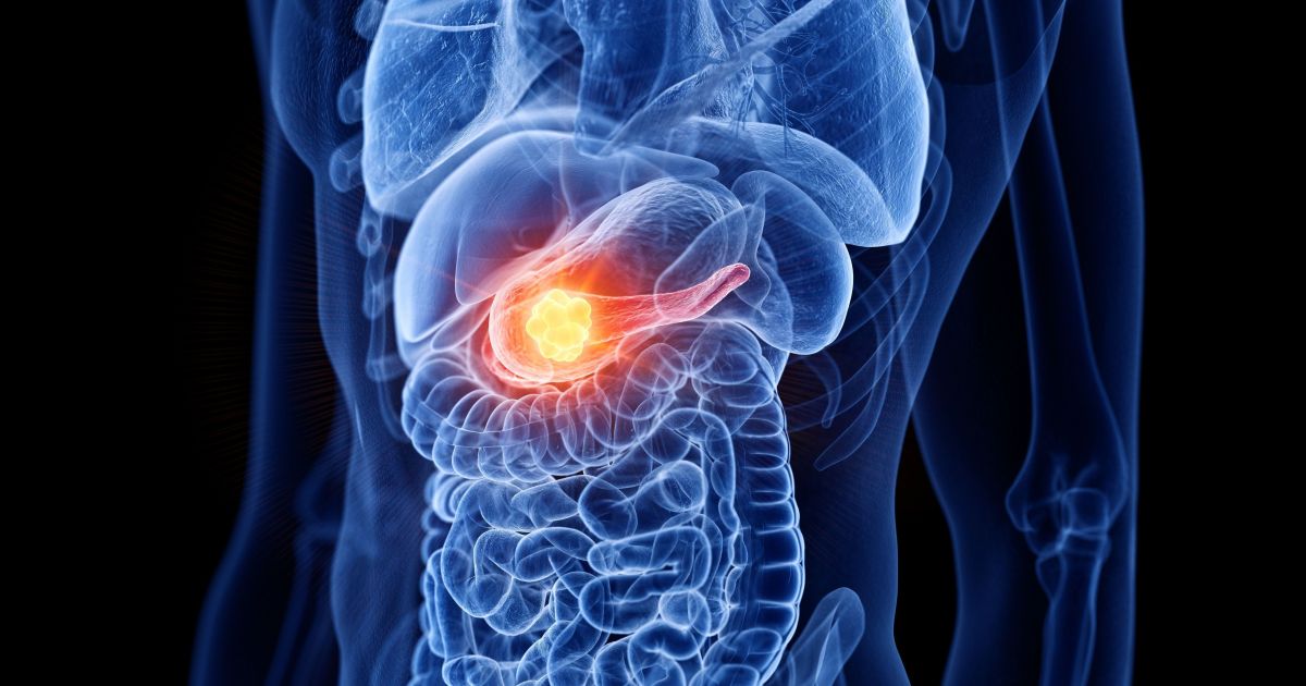 estudo-revela-proteina-ligada-ao-avanco-do-cancer-de-pancreas-pelos-nervos