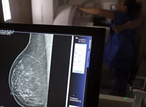 cancer-de-mama:-uma em-cada-tres pacientes tem-menos-de-50-anos